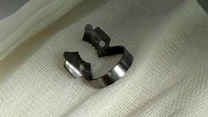 Подмосковные врачи спасли ребенка со стоматологической скобкой в желудка