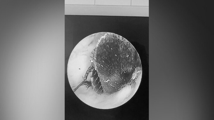 Врачи в Подмосковье извлекли из уха девушки живого таракана